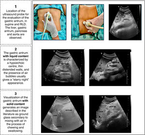 Visualization of the gastric antrum by gastric ultrasound, with different gastric contents. Abbreviations: RLD, right lateral decubitus.