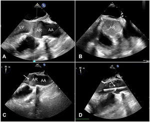 Transoesophageal echocardiography (TOE). A) 3-chamber view showing spontaneous echo contrast in the left ventricle and aortic root. B) Mid-oesophageal aortic valve short axis cross-section showing spontaneous echo contrast in the aortic root. C) 3-chamber view showing aortic valve opening (white arrow). D) Real-time TOE showing opening of the aortic valve (white arrow) after start of drainage (3-chamber view). AA: Ascending aorta; AR: Aortic root; LV: Left ventricle.