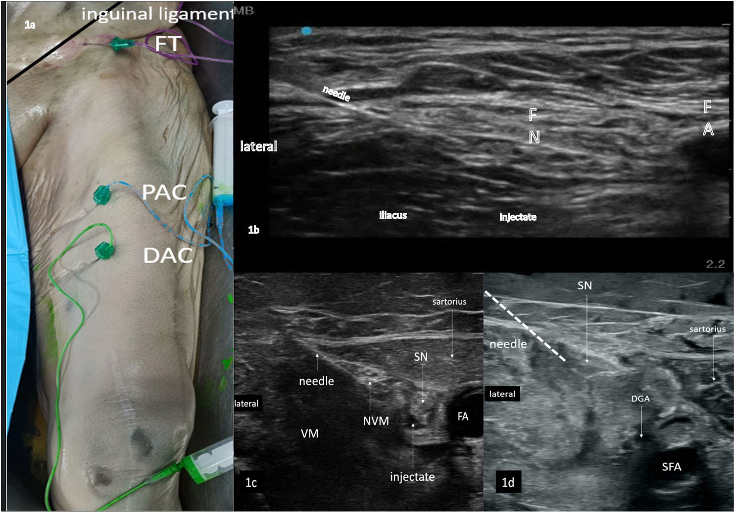 Investigation of dye spread following ultrasound guided injection at ...