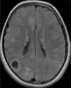 Axial FLAIR MRI, revealing right parietal cyst-like cortical tuber.