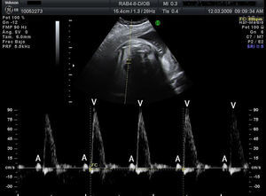Simultaneous Doppler recording of superior vena cava and aorta: sinus bradycardia in which each ventricular contraction (V: antegrade aortic flow) is preceded by retrograde flow in the superior vena cava caused by the atrial contraction (A).