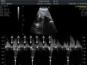 Simultaneous Doppler recording of superior vena cava and aorta: third degree atrioventricular block in which atrial contractions (A) and ventricular contractions (V) are independent.