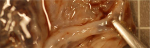 Macroscopic view of the placenta showing velamentous insertion of the umbilical cord.