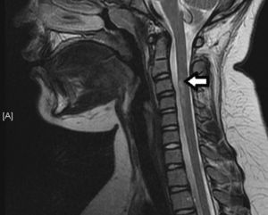 Thickening of the spinal cord in the segment between the bodies of the C3 and C4 vertebrae, with a high signal intensity fusiform lesion (T2) affecting the anterior and peripheral portion of the spinal cord.