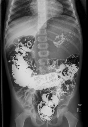 Case 1, marked gastric distension that did not extend to other parts of the digestive tract, with barium remnants from the previous study.