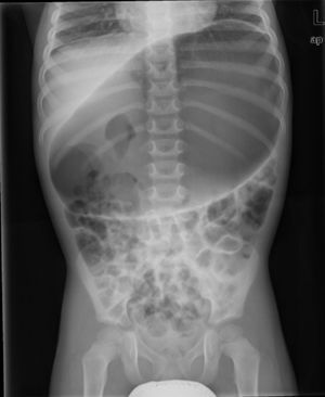 Case 2, gross gastric distension with stomach lying on a horizontal plane, compatible with gastric volvulus.
