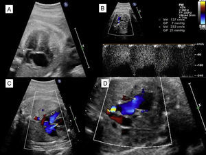 Severe premature constriction of the ductus arteriosus. (A) Four-chamber view showing dilatation of the right heart chambers with the foramen ovale flap bulging into the left atrium. (B) Doppler of the ductus arteriosus revealing a continuous blood flow with increased systolic and diastolic flow velocities. (C) Severe tricuspid regurgitation. (D) Three-vessel view showing a reduced ductal diameter.