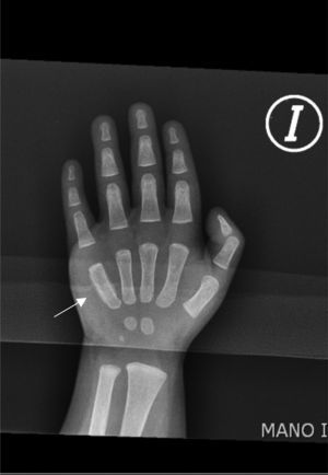 Left hand radiograph: periostic reaction in the fifth metacarpal bone.