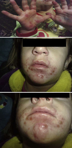Presentation of lesions in hand, foot and mouth disease.