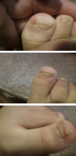 Presentation of onychomadesis in hand, foot and mouth disease.