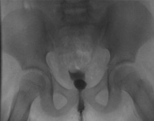 Case 1. Double outline in the late voiding film of the VCUG that shows a partially filled bladder with a superimposed round outline (more radiopaque) corresponding to the vagina.