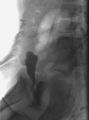 Case 2. Double outline of the bladder neck in the late voiding film. The image shows the presence of contrast medium in the vagina (posterior to the urethra).