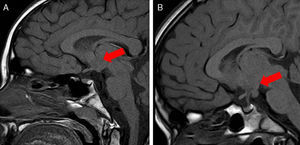 T1 sagittal view showing hypothalamic hamartoma in patient 1 (A) and patient 2 (B).