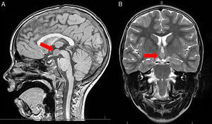 Hypothalamic hamartoma measuring 1.3cm×0.8cm×1cm at the floor of the third ventricle, affecting the tuber cinereum, and between the mamillary bodies (A) T1 sagittal view and (B) T2 coronal view.