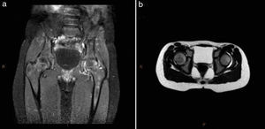 Pelvis MRI. (a) Inflammatory response of the articular capsule of the left hip with contrast enhancement in a fat-suppressed T1 image. (b) Increase in joint fluid in the left hip in T2-weighted image.