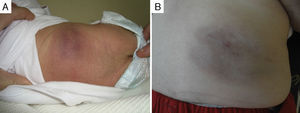 (A) Congenital tufted angioma in the lumbar region of a child. (B) After 6 months of followup with no treatment, the lesion shows involution with a reduction in its deep component and in the intensity of the surface colouration.