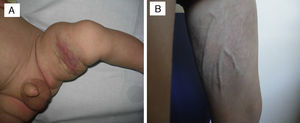 (A) Tufted angioma in right inner thigh measuring 10cm×15cm, present since birth, previous to treatment with 2mg/kg/day of propanolol for 3 months. (B) Four-year followup: the lesion had regressed, leaving behind subcutaneous atrophic tissue.