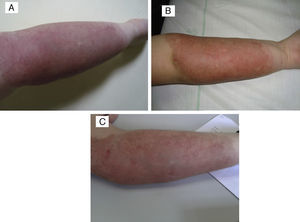 (A) Tufted angioma associated with arteriovenous malformation. (B) After a 5-month course of 2mg/kg/day of propanolol, the lesion remained unchanged, with no improvement. (C) Parameters after three PDL sessions: spot 7mm, 0.5ms and 9, 10 and 10.5J/cm2, with clinical improvement and no scars.