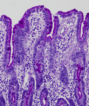 PAS stain. Accumulation of PAS-positive material in the apical cytoplasm of enterocytes.