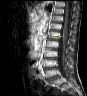 MRI axial projection of the lumbosacral spine (T1-weighted sequence), showing a tenuous contrast uptake by the roots of the cauda equina.