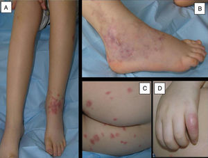Skin lesions in case 1. (A) Painful swelling in left ankle with purpuric lesions in the anterior surface. (B) Livedo reticularis with haemorrhagic suffusion in the external lateral surface of the right ankle. (C) Isolated purpuric lesions in the buttocks. (D) Skin nodule in the fifth finger of the right hand.