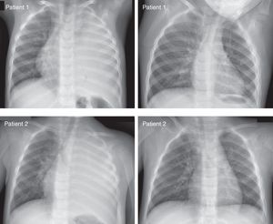 Initial and last chest X-ray of two representative patients with a very large complicated pleural effusion not drained. The time elapsed between the two images of each patient was (as usual in most of our cases) about 3 months.