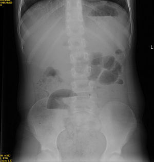 Image of incipient DIOS, with a bubbly appearance of the caecum, right iliac fossa and sigmoid colon. Air-fluid level at the right iliac fossa and absence of distal gas.