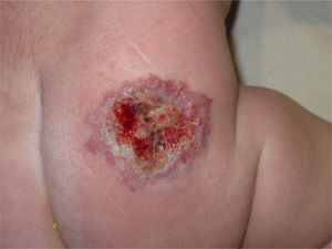 Patient with ulcerated haemangioma in the nappy area.