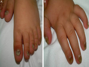 (A) Distal subungual hyperkeratosis and chromonychia in feet. (B) Distal subungual hyperkeratosis and chromonychia in hands.