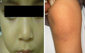 (A) Localised steatocystoma in cheeks. (B) Keratosis pilaris in knees.