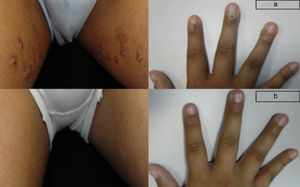 Patient aged 13 years, with bilateral viral warts in the inguinal region and fingers (a), resolution of lesions after two months’ treatment (b).