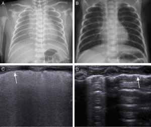 (A) Chest radiograph in a newborn with respiratory distress syndrome. (B) Chest radiograph of the newborn at the time of discharge. (C) Longitudinal lung ultrasound in the same patient, showing a diffuse and compact pattern of lines. The arrow points at the thickened and irregular pleura. Once the patient was intubated, lung sliding was observed bilaterally. (D) Longitudinal lung ultrasound of the patient with a normal hyperechoic pleural line. A lines are thin and parallel to one another, with discernible rib shadows confirming normal appearance without B lines or comet tail artefacts.