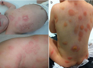 Cases 1 and 3. Multiple erythematoedematous and bullous lesions, some of them slightly yellow, 1–2cm in size and distributed through the entire body surface area.