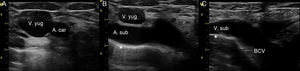 Ultrasound exploration of the right BCV. (A) Transverse plane of the right internal jugular and carotid. (B) Sliding the transducer, following the internal jugular, the subclavian artery is identified. (C) Tilting the transducer anteriorly, the longitudinal axis of the subclavian vein is obtained, and its continuation to the BCV. Indicating the pleura.