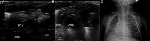 Cannulation of left BCV. (A) Longitudinal plane of left BCV. (B) CVC placement control during the procedure. Note the close relation between the left BCV and the aortic arch. (C) Final position of the CVC in the upper part of the SVC. *Indicates the tip of the needle penetrating the vessel.