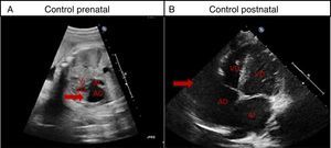 Case 1. Right atrial appendage enlargement. (A) Foetal ultrasound at 31 weeks’ gestation, arrow points at right atrial enlargement. (B) Ultrasound: last postnatal followup at 18 months of age showing enlargement of right atrial appendage 5cm2 in diameter (arrow). AD, right atrium; AI, left atrium; VD, right ventricle; VI, left ventricle.