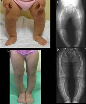 Physical and radiographic characteristics of the lower extremities of Case 1 at diagnosis (A and B) and after two years of treatment (C and D).