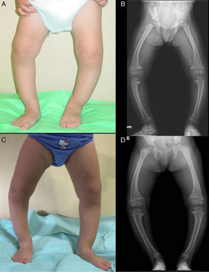 Physical and radiographic characteristics of the lower extremities of Case 2 at diagnosis (A and B) and after two years of treatment (C and D).