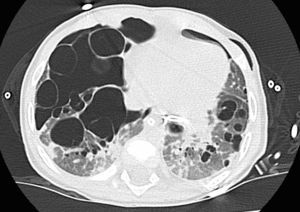 High-resolution CT: multiple bilateral cyst-like lesions with left pneumothorax, mediastinal shift and partial left lung collapse.