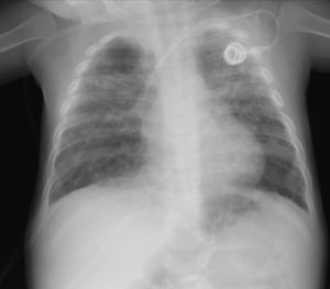 Chest X-ray 48h after performance of ABP.