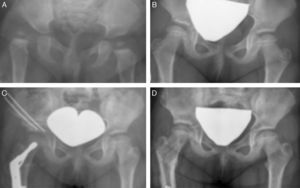 Clinical case number 12. (A) Diagnosis of DDH at age 8 months treated conservatively with a series of spica casts. (B) Outcome of conservative orthopaedic treatment at age 6 years, with acetabular dysplasia, a coxa valga deformity, and a disrupted Shenton's line. (C) Surgical treatment with a Salter osteotomy, combining transplantation of an allograft from a tissue bank with a femoral varus derotation osteotomy. (D) Final outcome at age 8 years.