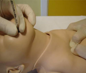 Chest compressions with the two-thumb technique.