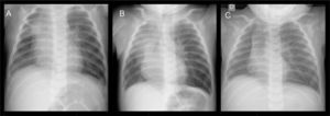 Chest X-rays at ages 4 months (A), 5 months (B) and 8 months (C). The major findings are the markedly reduced size of the right lung and the ipsilateral mediastinal shift, and left lung hyperinflation with herniation of the left upper lobe.