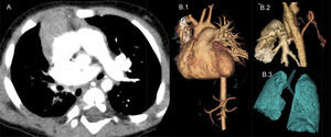 (A) Chest helical CT with contrast revealing right pulmonary artery agenesis and right pulmonary hypoplasia. (B) Chest helical CT with 3D image reconstruction. (B.1) Detail of right pulmonary artery agenesis. (B.2) Collateral vessels originating in the descending aorta that supply the right lung parenchyma. (B.3) Right pulmonary hypoplasia.