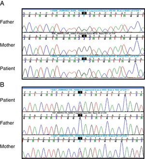 Electropherograms showing variant c.502G>A (p.Ala168Thr, rs374601719) in exon 4 (A) and variant c.877C>T (p.Gln293*) in exon 7 (B).
