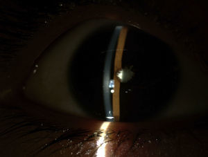 Biomicroscopy of the right eye, revealing whitish keratic precipitates on the posterior part of the cornea, Tyndall-positive complete posterior synechiae and white mature cataract.