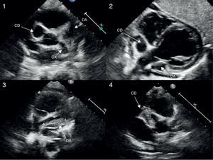 Echocardiogram (modified high parasternal short-axis view at the level of the large arteries for assessment of aortic arch and coronary arteries) revealing the presence of giant aneurysms in the proximal segments of the three major coronary arteries (images 1 and 2). Follow-up echocardiogram showing intraluminal thrombi in the LAD and RCA, with preserved systolic function (images 3 and 4).