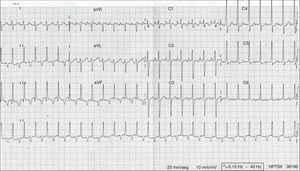 Electrocardiograph showing features of junctional atrioventricular reciprocating tachycardia. Regular tachycardia with narrow QRS complex, long RP interval (RP>PR) and a negative P-wave in the inferior leads (II, III and aVF).