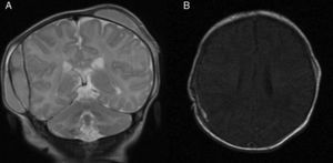 (A and B) Preoperative and postoperative magnetic resonance scan of the patient corresponding to case 2. The first one shows the mass effect, and the second the complete disappearance of the haematoma.