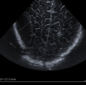 Preoperative transfontanellar ultrasound in case 3. Biconvex hypoechoic mass measuring 48×22.5mm in the right parietal posterior region, suggestive of epidural haematoma.